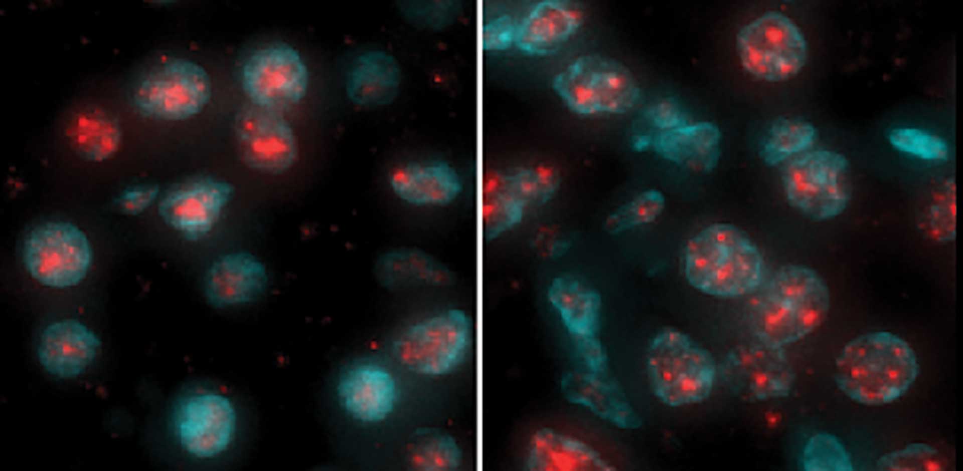 image of ccRCC tumor cell speckles